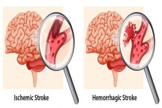 Effective Ways to Reduce Your Risk of Stroke