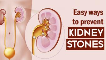 Prevention of Kidney Stones